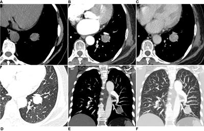 Magnetic resonance imaging findings of pulmonary sclerosing pneumocytoma: a case report and literature review